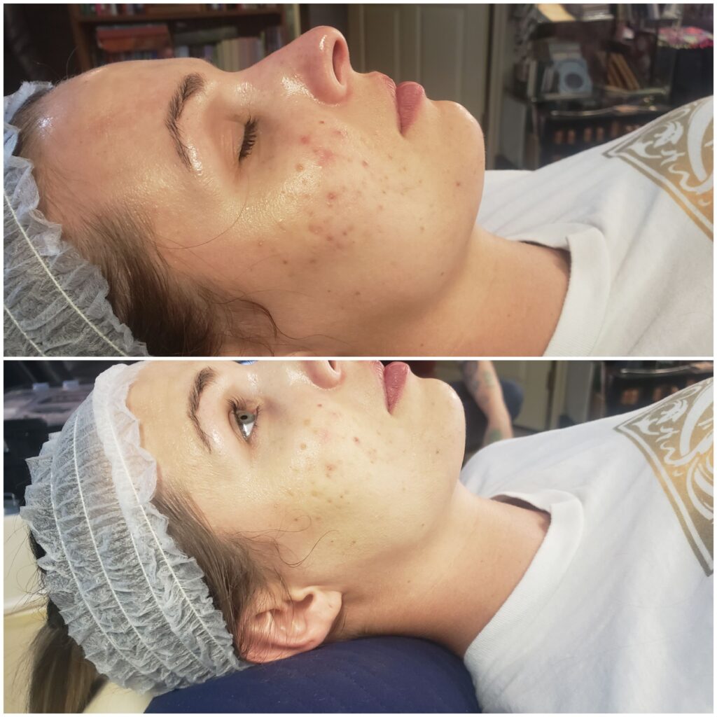 Microneedle for acne scars, stretch marks, and anti aging. PRP Vampire Facial Camp Verde AZ